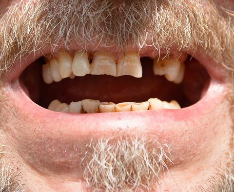 Desgaste dentário provocado por bruxismo ou erosão dentária.