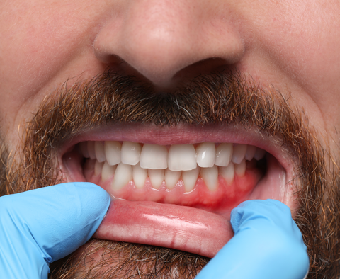Gengivas vermelhas e inflamadas durante uma avaliação de saúde oral.